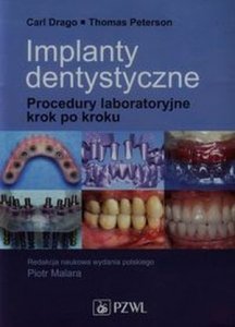 Implanty dentystyczne Procedury laboratoryjne krok po kroku