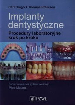 Implanty dentystyczne Procedury laboratoryjne krok po kroku